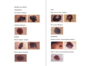 regra-abcd-cancer-de-pele-melanoma